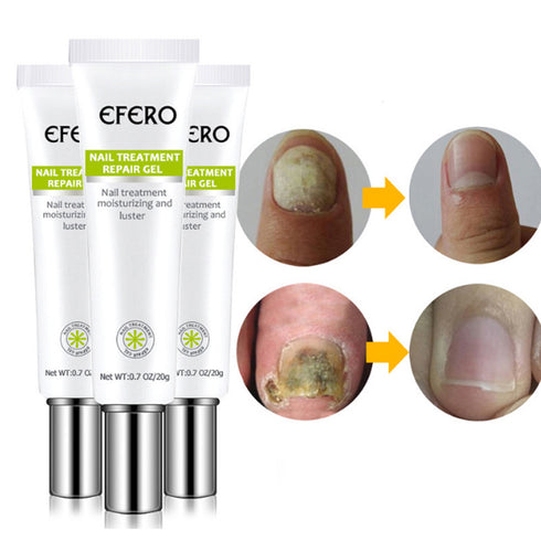 Nail Treatment Serum Nail Foot Nail Fungus Removal Gel Anti Infection Onychomycosis Nail Repair Essence Cream Feet Care - ROUTINE FASHION