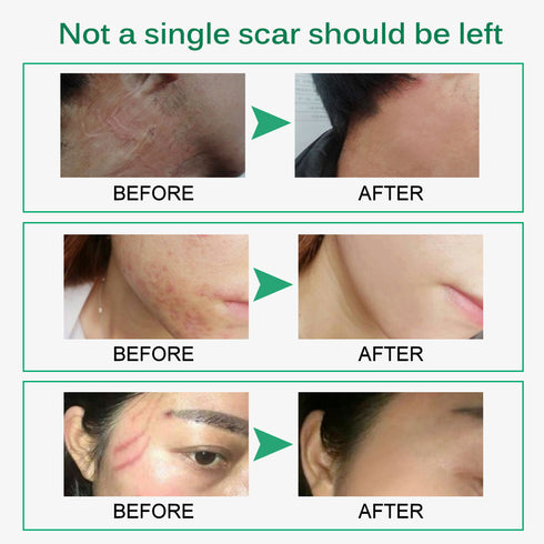 Skin Rebound Scarless Cream Scar Removal Cream Face Cream For Face Acne Scar Stretch Marks Skin Repair Face Cream - ROUTINE FASHION